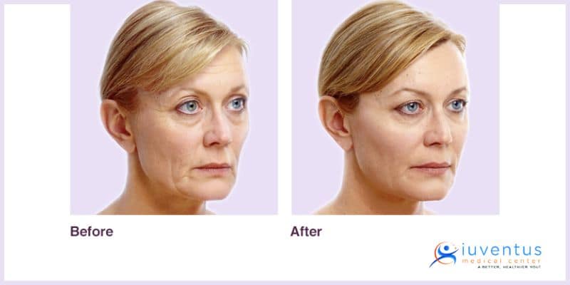 dermal fillers