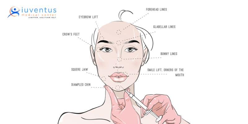dermal filler procedure