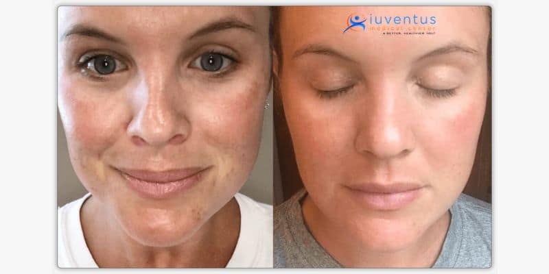 What Are the Benefits of PRP