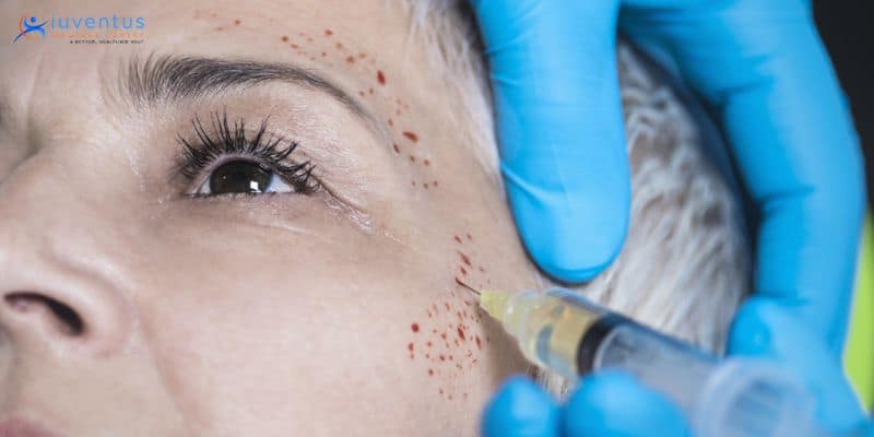 What Is Platelet-Rich Plasma Therapy