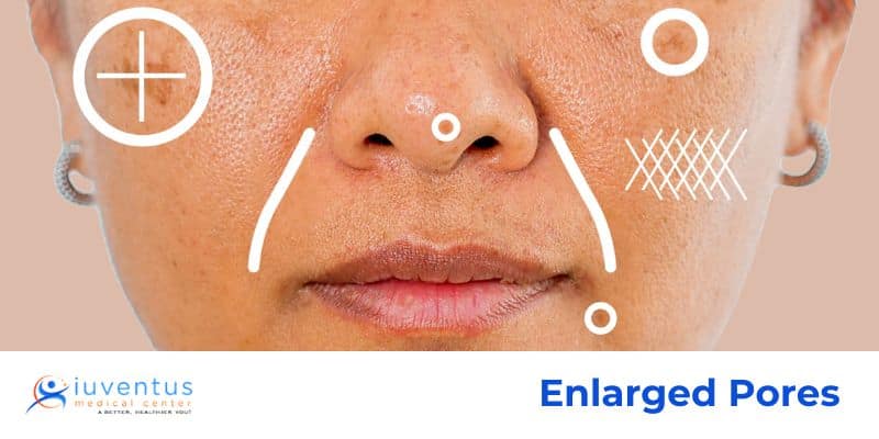 Enlarged Pores