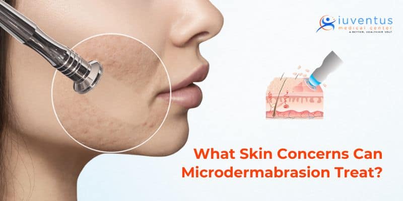 Skin Concerns on Microdermabrasion